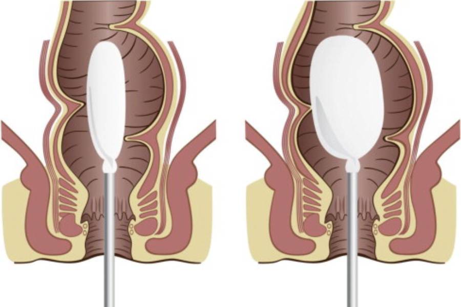 Anorectal Manometry in pune