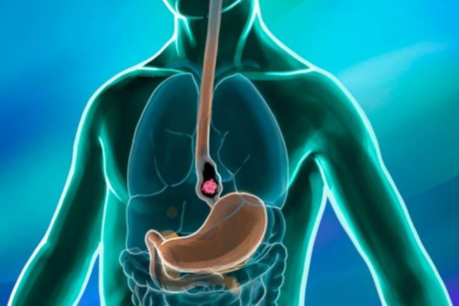 Esophageal Cancer Treatment