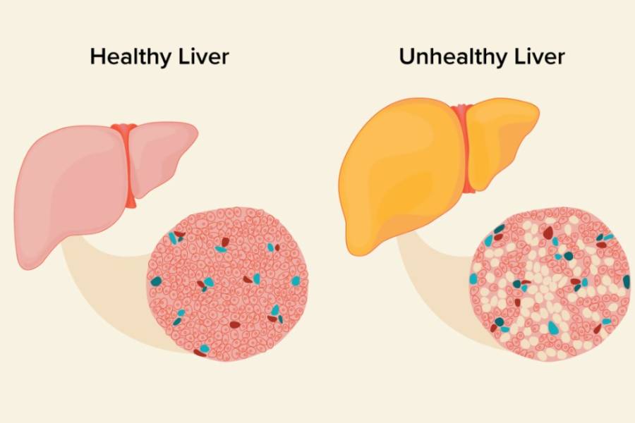 Fatty Liver Disease treatment in Pune