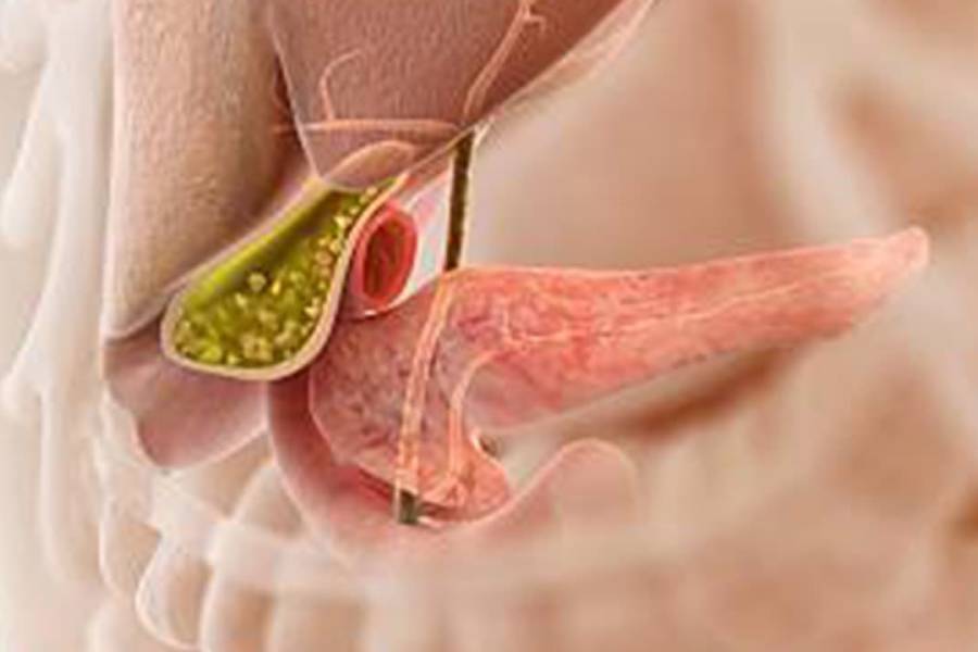 Gallstones treatment in Pune