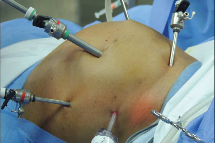 Laparoscopic Rectopexy in Pune