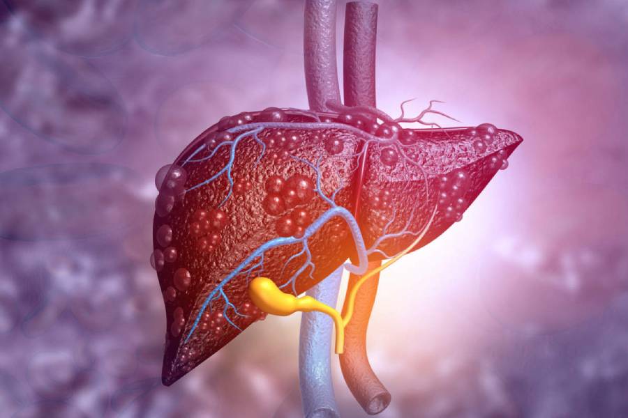 Liver Cirrhosis Treatment in Pune