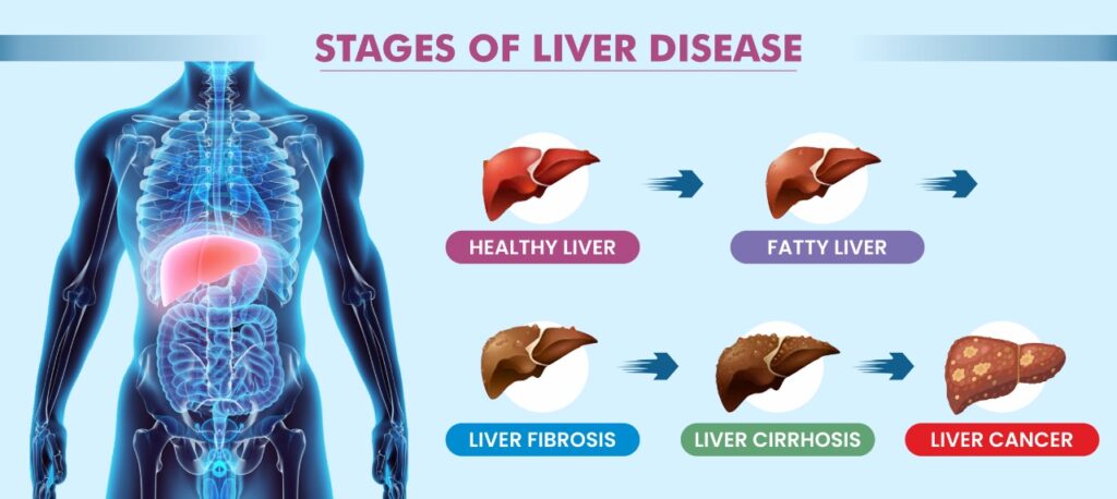 Liver Cirrhosis Treatment in Pune- Kaizen Gastro Care