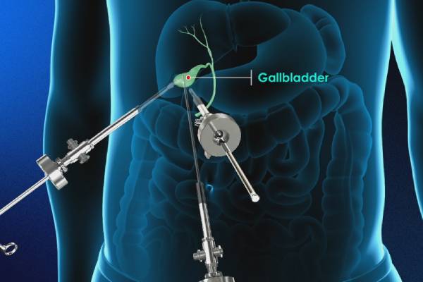 Gallbladder Removal Surgery in Pune