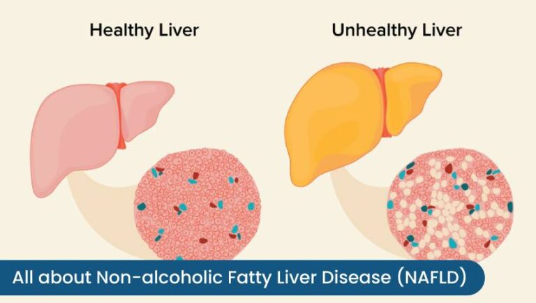 Non-alcoholic Fatty Liver Disease | Kaizen Gastro Care
