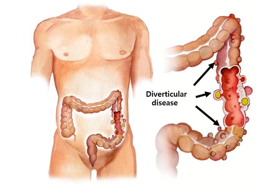 Diverticular Disease Treatment