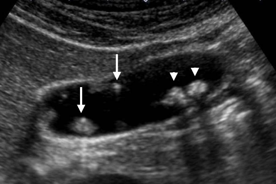 Gallbladder Polyps Treatment in Pune