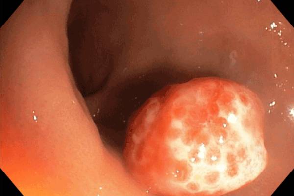 Solitary Rectal Ulcer Syndrome Treatment