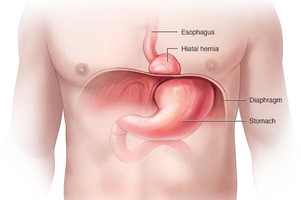 Hiatal Hernia Treatment in Pune