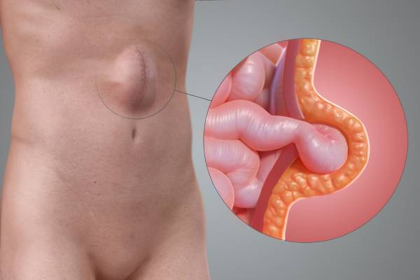 Incisional Hernia Treatment in Pune