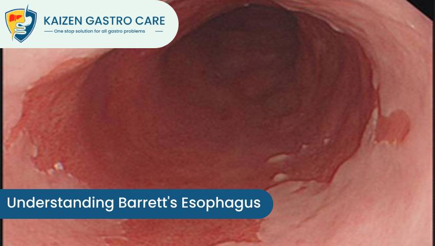 Barrett's Esophagus