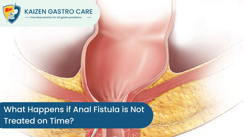 Anal Fistula