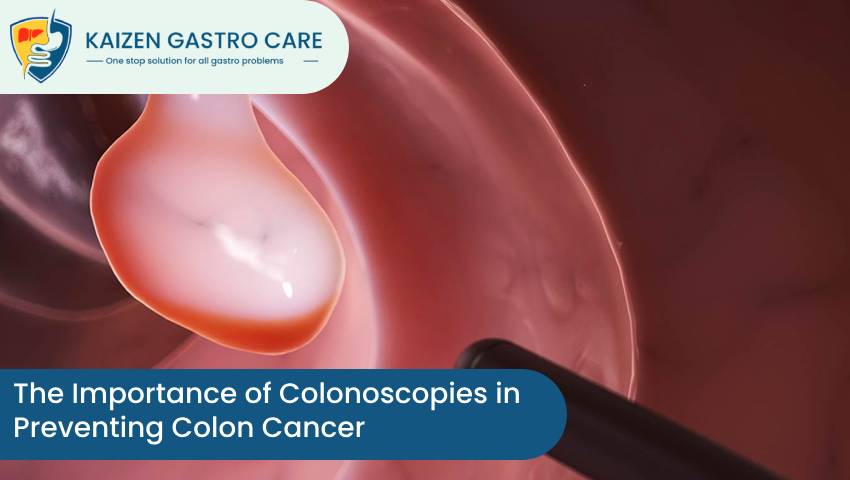 Importance of Colonoscopies