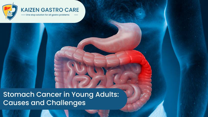 Stomach Cancer in Young Adults