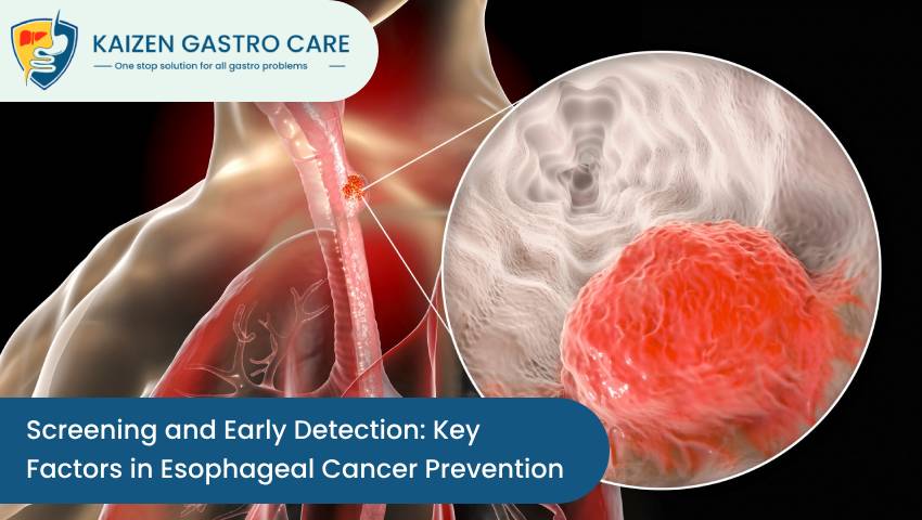 Esophageal Cancer Prevention