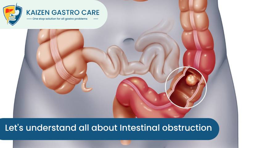 Intestinal obstruction