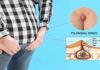 Pilonidal Cyst: Causes, Symptoms, and Treatment Options