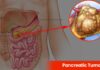 Pancreatic Tumors: Signs and Symptoms You Shouldn’t Ignore