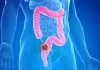 Why Is Colon Cancer Becoming More Common in Young Adults?