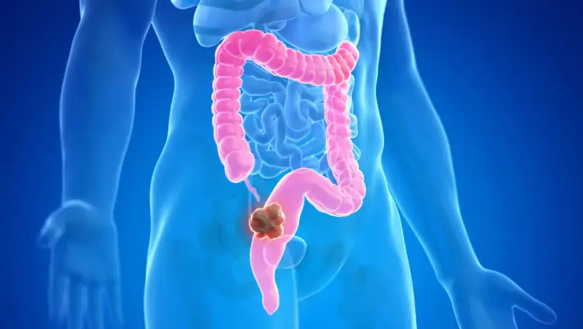 Why Is Colon Cancer Becoming More Common in Young Adults?