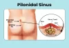 Early Signs of Pilonidal Sinus You Shouldn’t Ignore