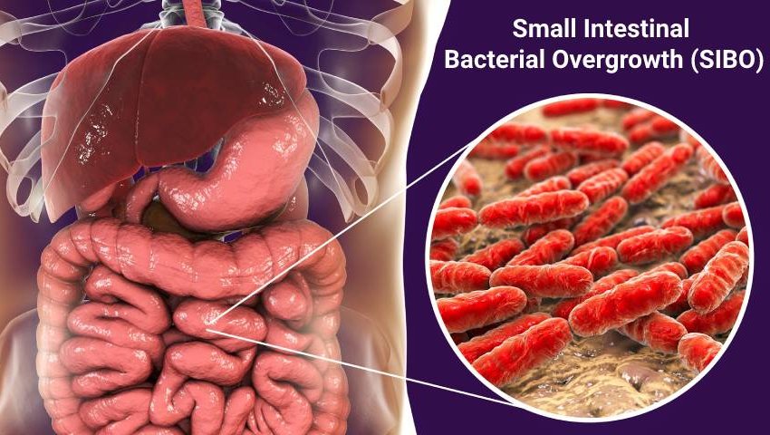 Small Intestinal Bacterial Overgrowth (SIBO): Understanding symptoms and treatment approaches