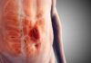 Visible abdominal hernia showing bulge near the abdomen
