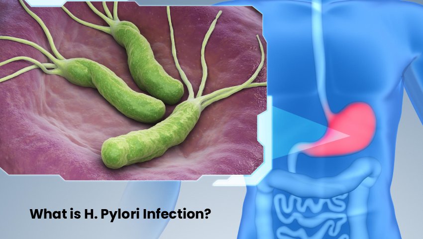 H. Pylori infection bacteria affecting stomach lining – Kaizen Gastro Care Pune