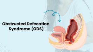 Hydrox Defecation Obstructed Defecation Syndrome & Constipation