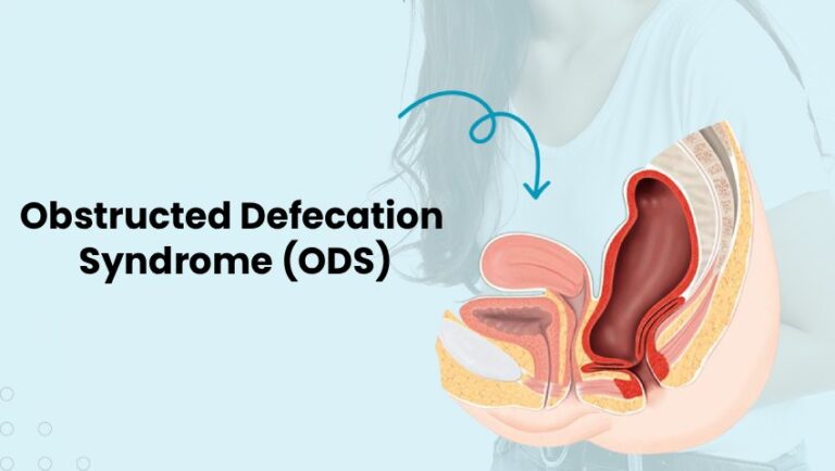 Obstructed Defecation Syndrome & Constipation