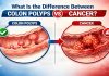 image showing Difference Between clon polyps and cancer