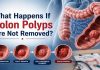 What Happens If Colon Polyps Are Not Removed? Expert Colon Polyps Treatment at Kaizen Gastro Care.